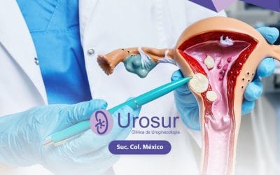 Miomas uterinos: causas, síntomas y cuándo es necesario tratarlos